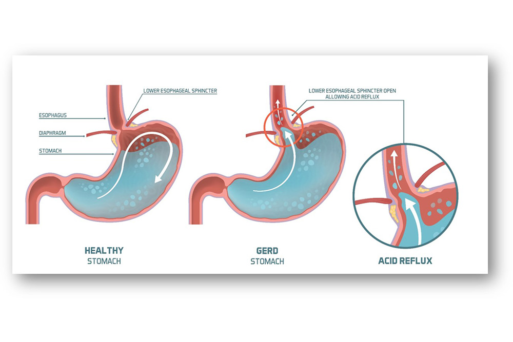 Reflux GastroOEsophagien ou dyspepsie fonctionnelle...