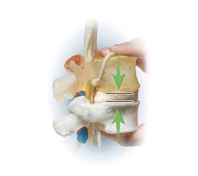 Natural Disc Height Narrowing Does Not Help with Cervical Spondylolisthesis