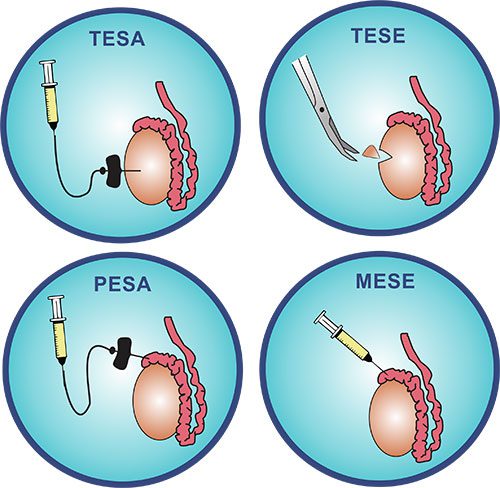 TESA Treatment Know the Cost & Success Rate in Delhi, India