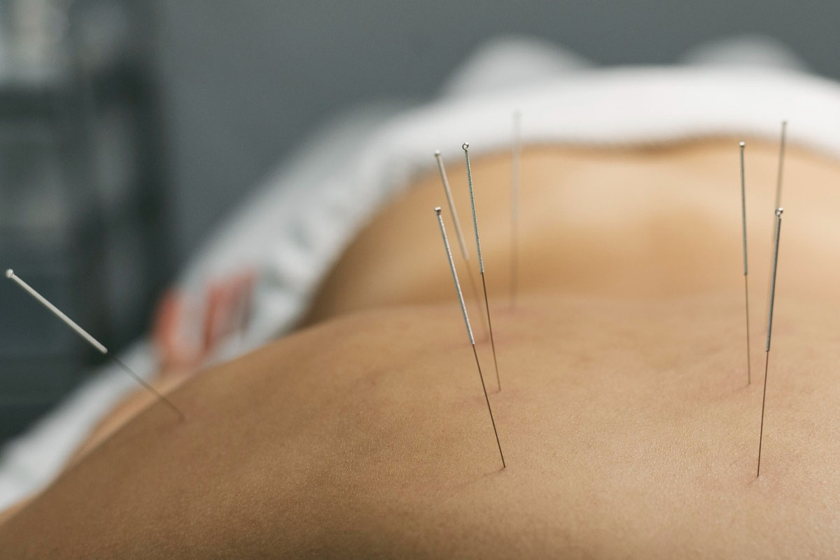 How Many Sessions Does Dry Needling Work?