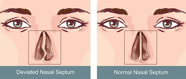 Atlanta Deviated Septum Specialists Atlanta ENT TOP