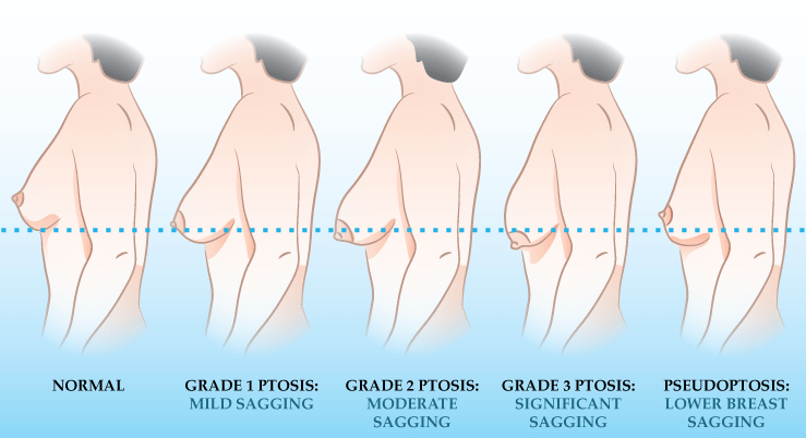 If I use a bigger implant, can I avoid a breast lift? Kavali Plastic