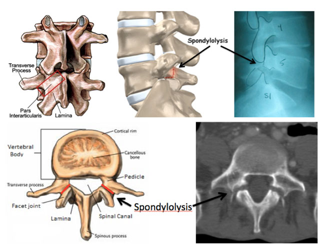 Spondylolysis (Pars Fractures) and Lytic Spondylolisthesis Dr. Paul