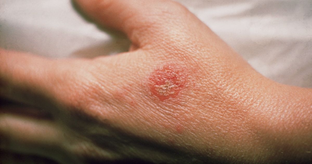 Proactive Methods For Treating Nummular Dermatitis