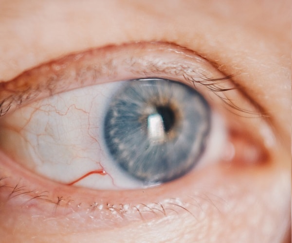 Blepharitis Dynan Opticians