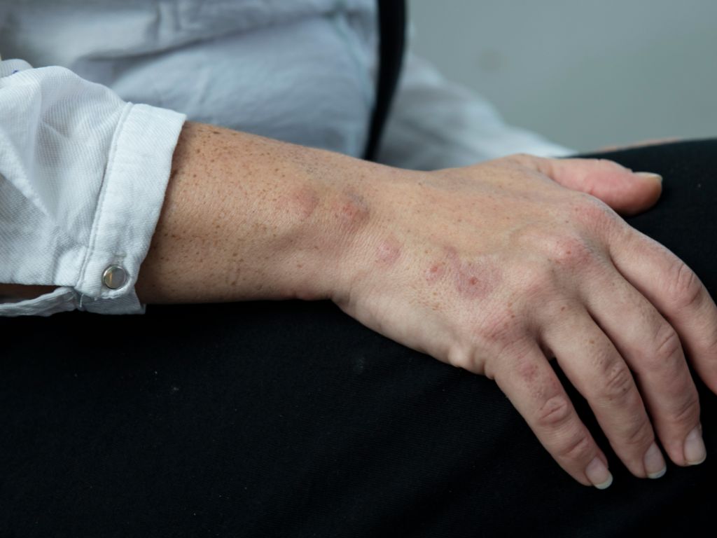 Bed Bug Bites Symtoms And Treatment DynoPest
