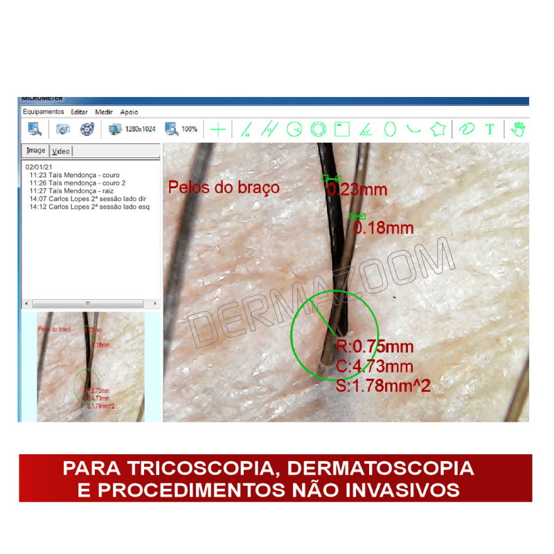 DermaZoom Micrometer