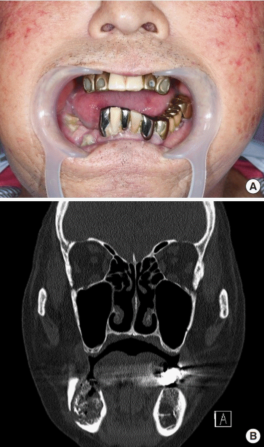 Chronic Osteomyelitis Jaw