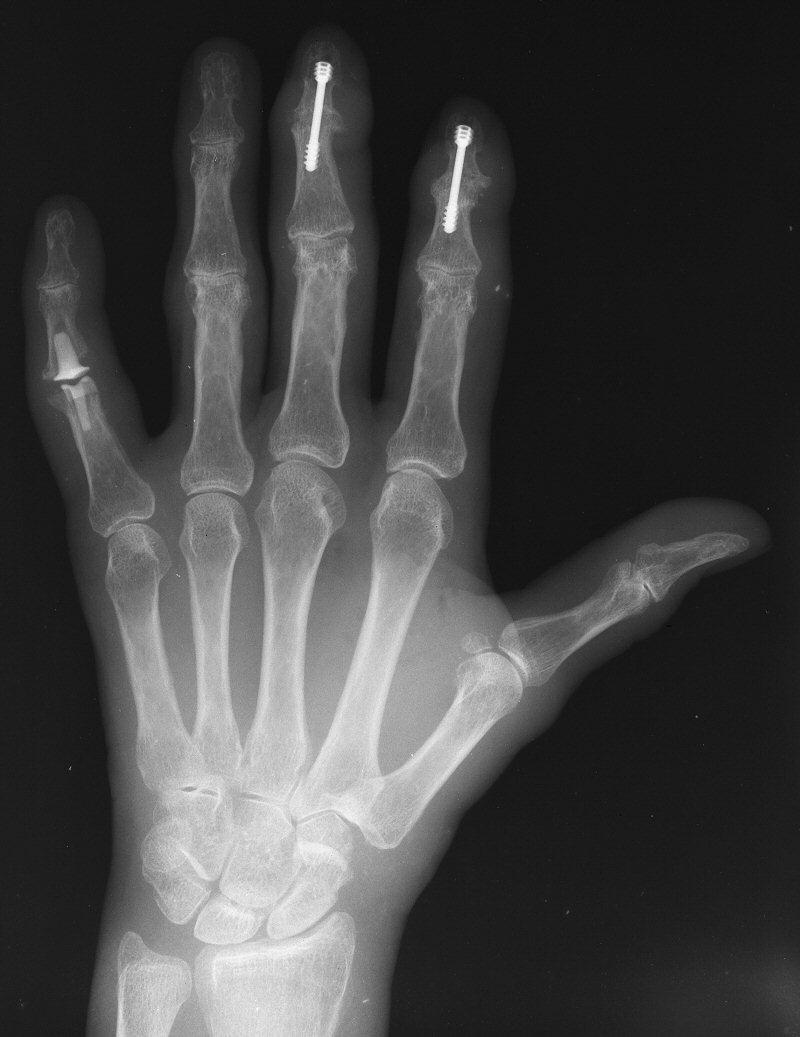 Arthritis Distal Interphalangeal Joint Arthroplasty with reversed