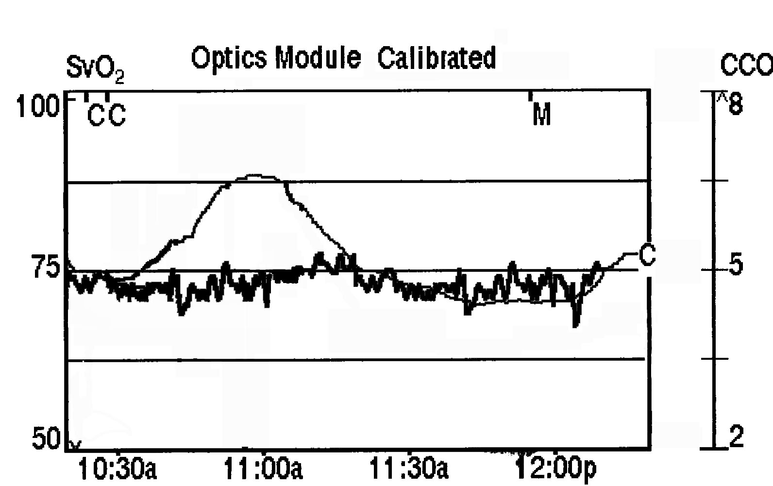 Acute and long term cardiovascular effects of basilic vein
