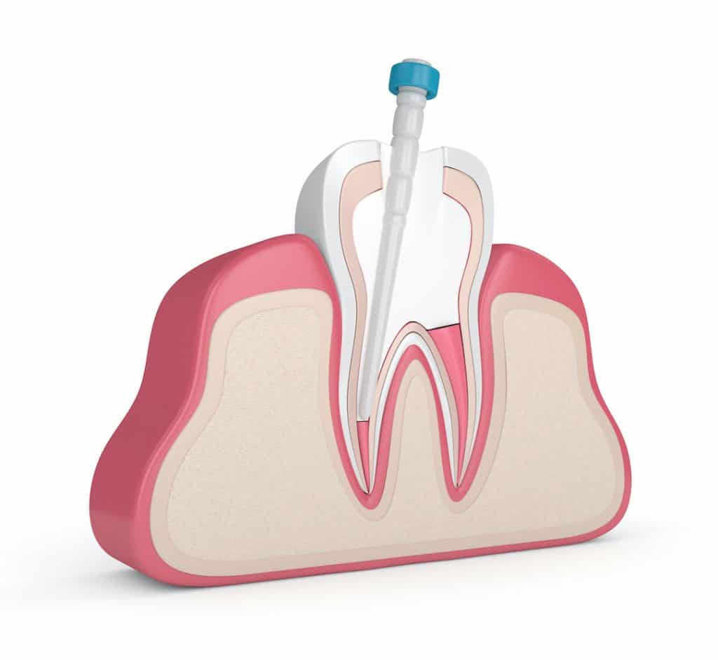 How to Know if a Root Canal is Needed Stonebrook Family Dental