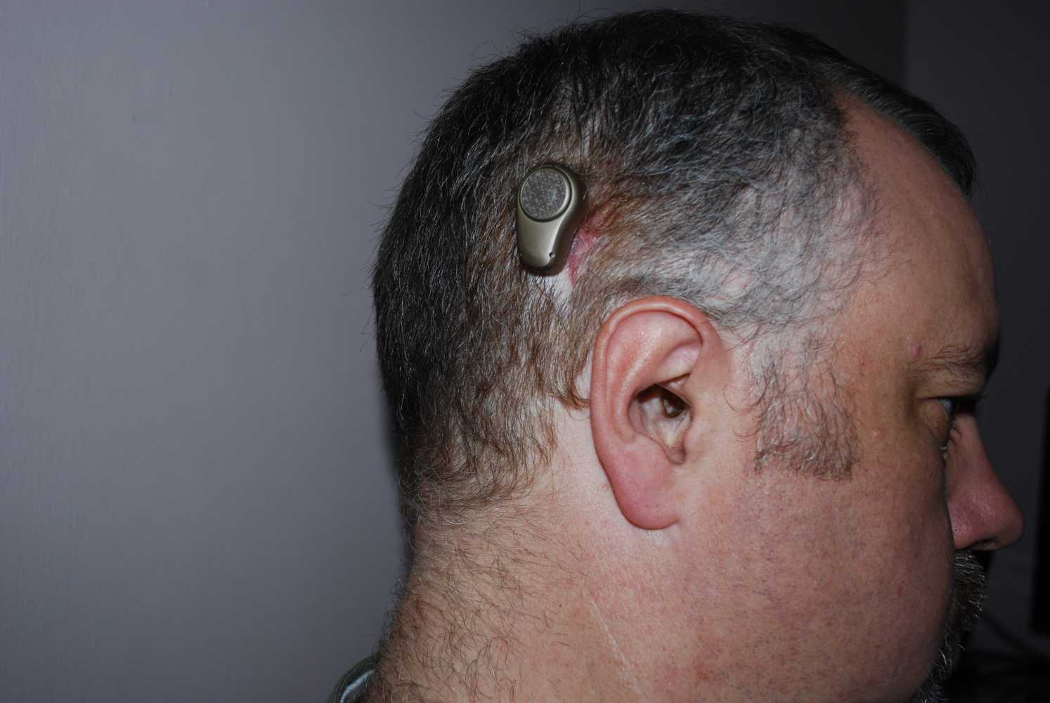 Community Photos Bone Conduction Hearing Devices Ear Community