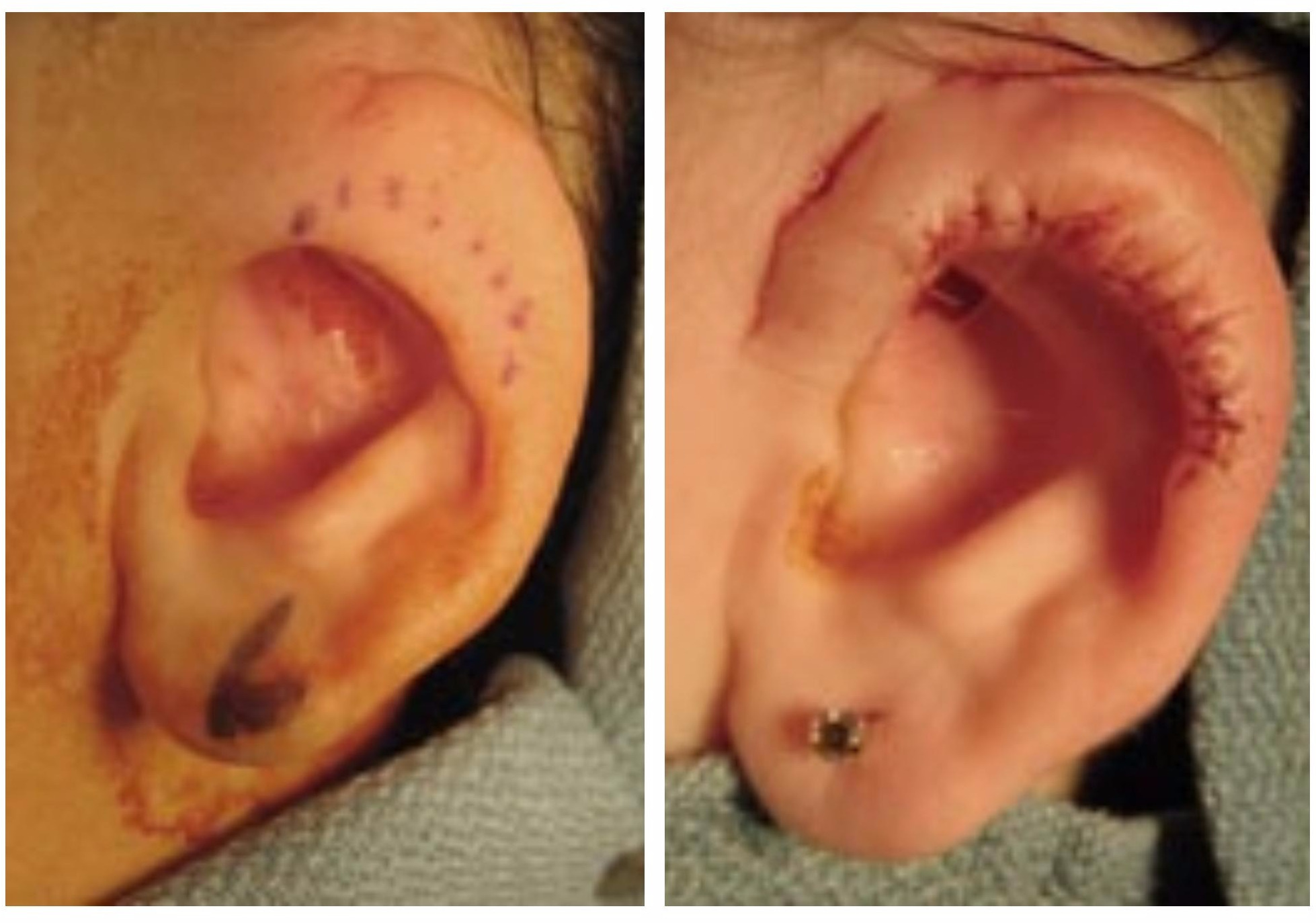 Soft Tissue Ear Community