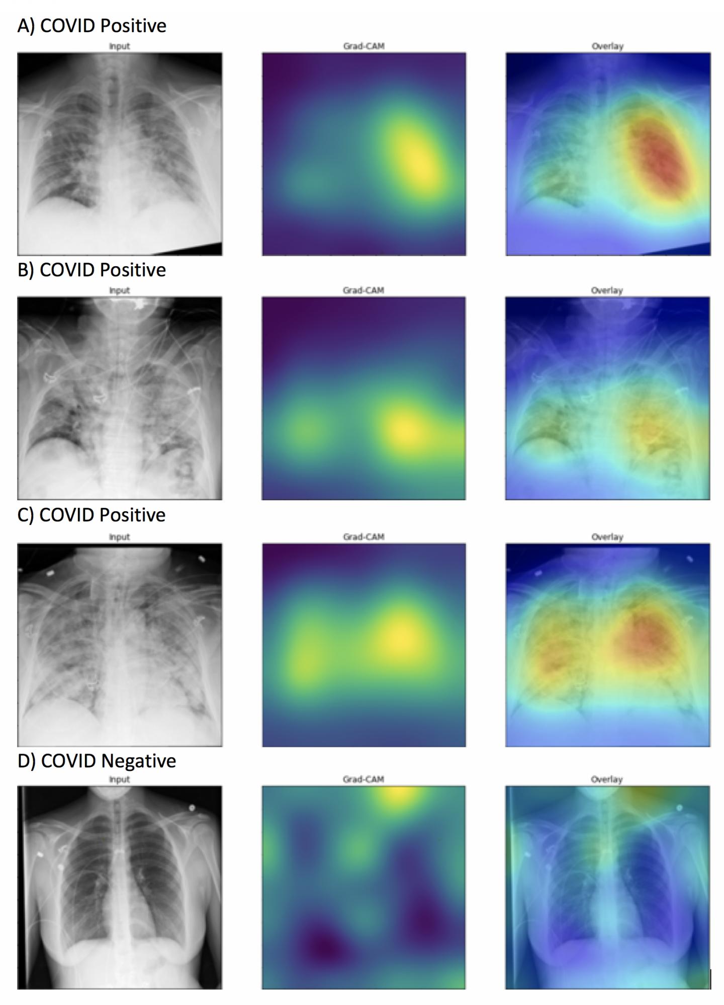 AI detects COVID19 on chest xrays with accu EurekAlert!