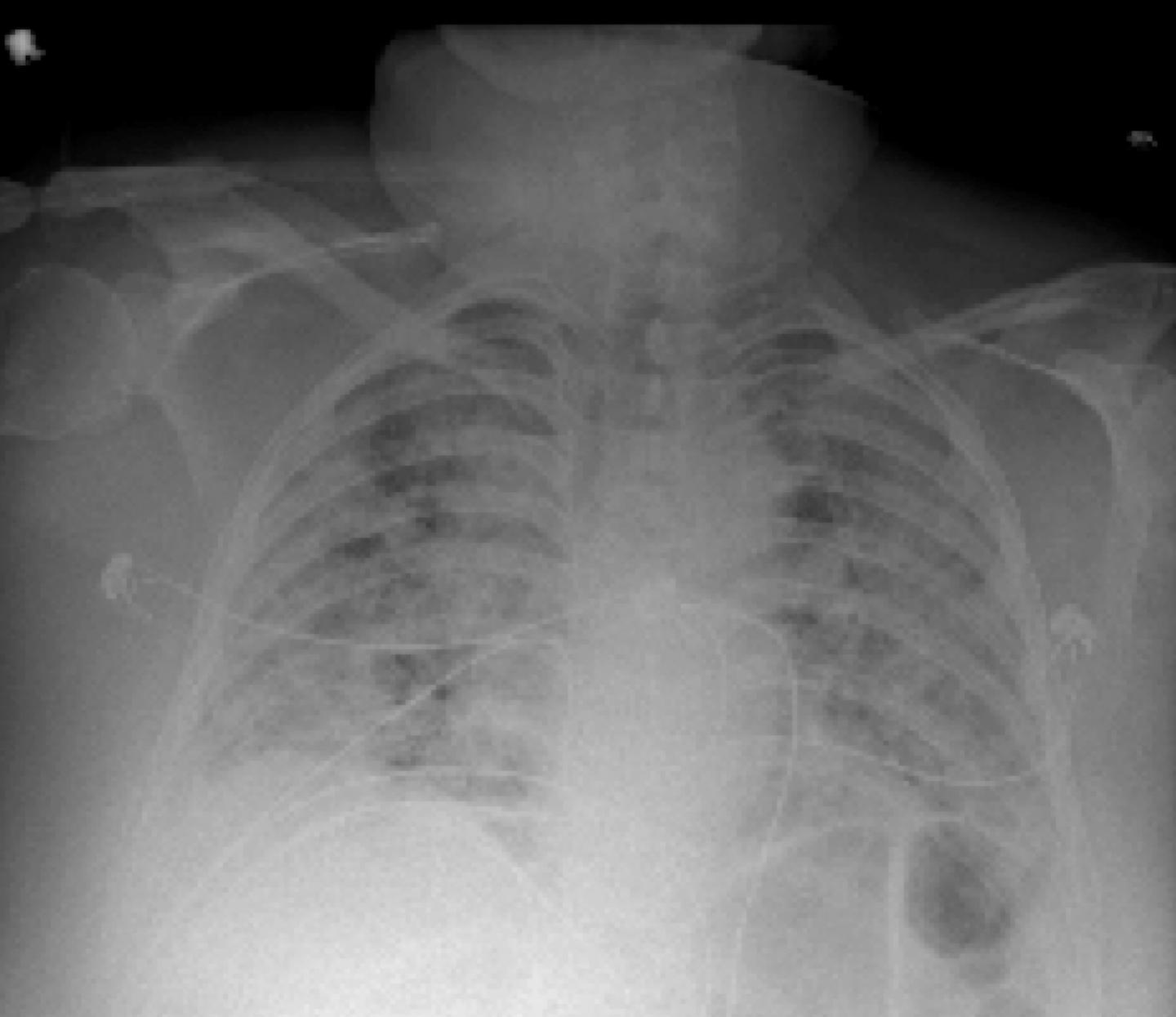 Artificial intelligence tool uses chest Xray EurekAlert!