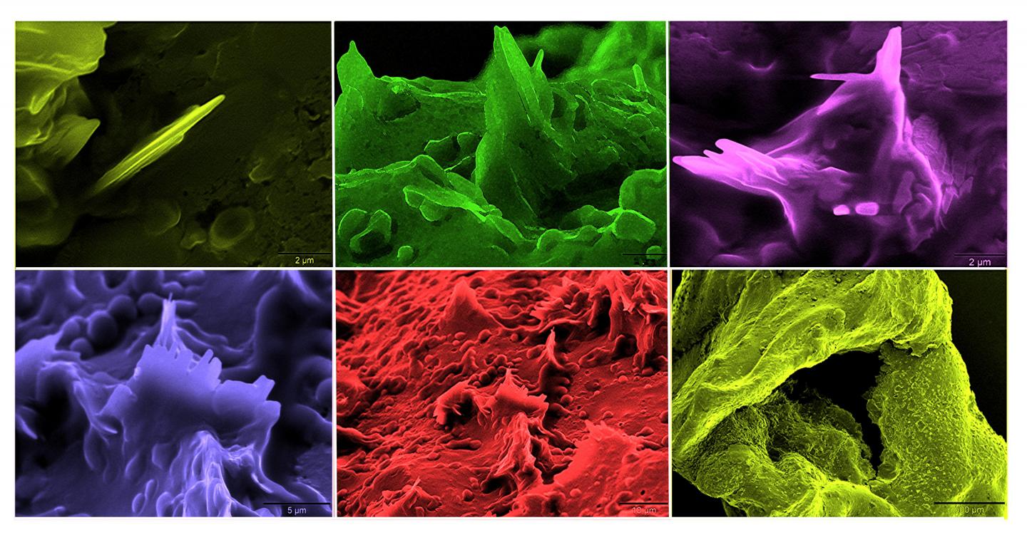 Cholesterol Crystals [IMAGE] EurekAlert! Science News Releases
