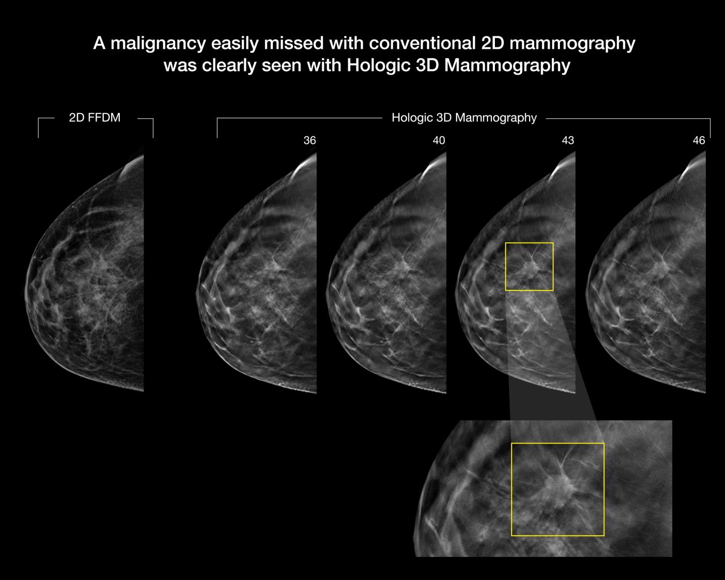3D mammography improves cancer detection in EurekAlert!