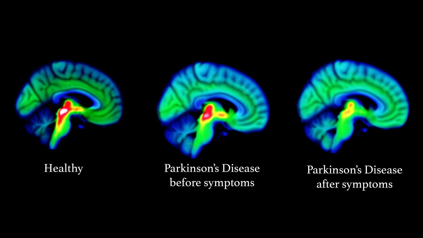 Progression of Parkinson's Dis [IMAGE] EurekAlert! Science News Releases
