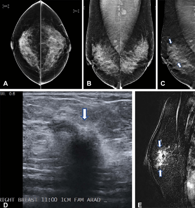 Huge Study Finds Tomosynthesis [IMAGE] EurekAlert! Science News Releases