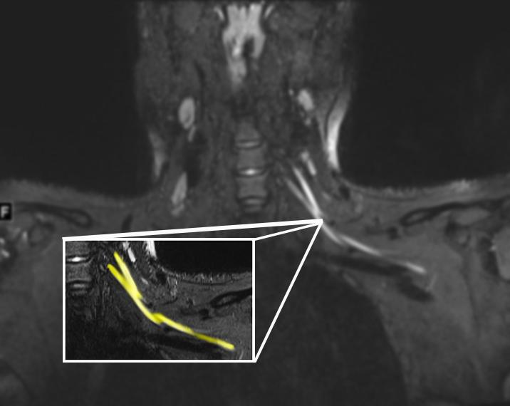 MRI shows nerve damage in neck [IMAGE] EurekAlert! Science News Releases
