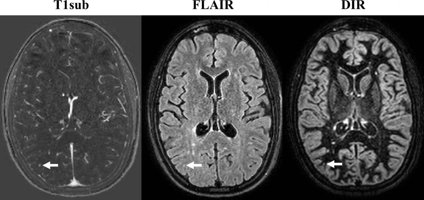 Noncontrast MRI is effective in monitoring M EurekAlert!