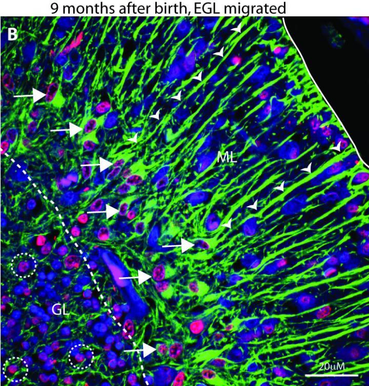 Prognostic Marker for Childhood Brain Cancer EurekAlert!