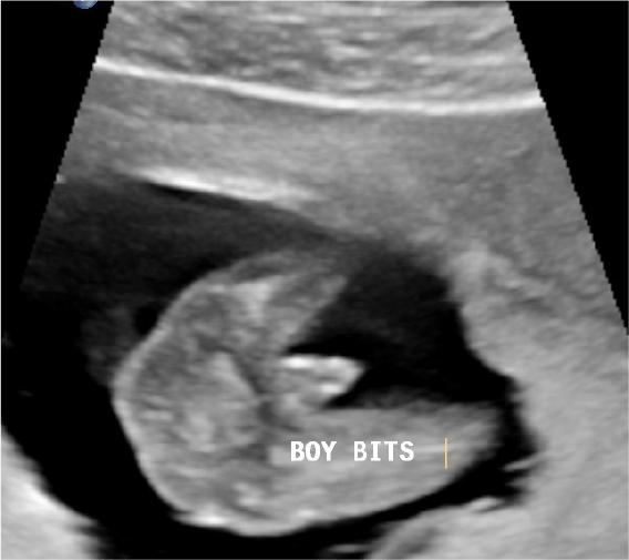 3D/4D Ultrasound Earlyview