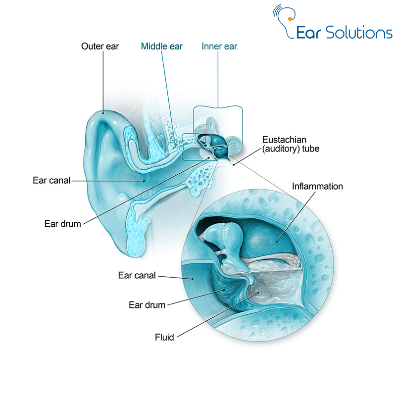 10 Common Causes of Hearing Loss and How to Prevent Them