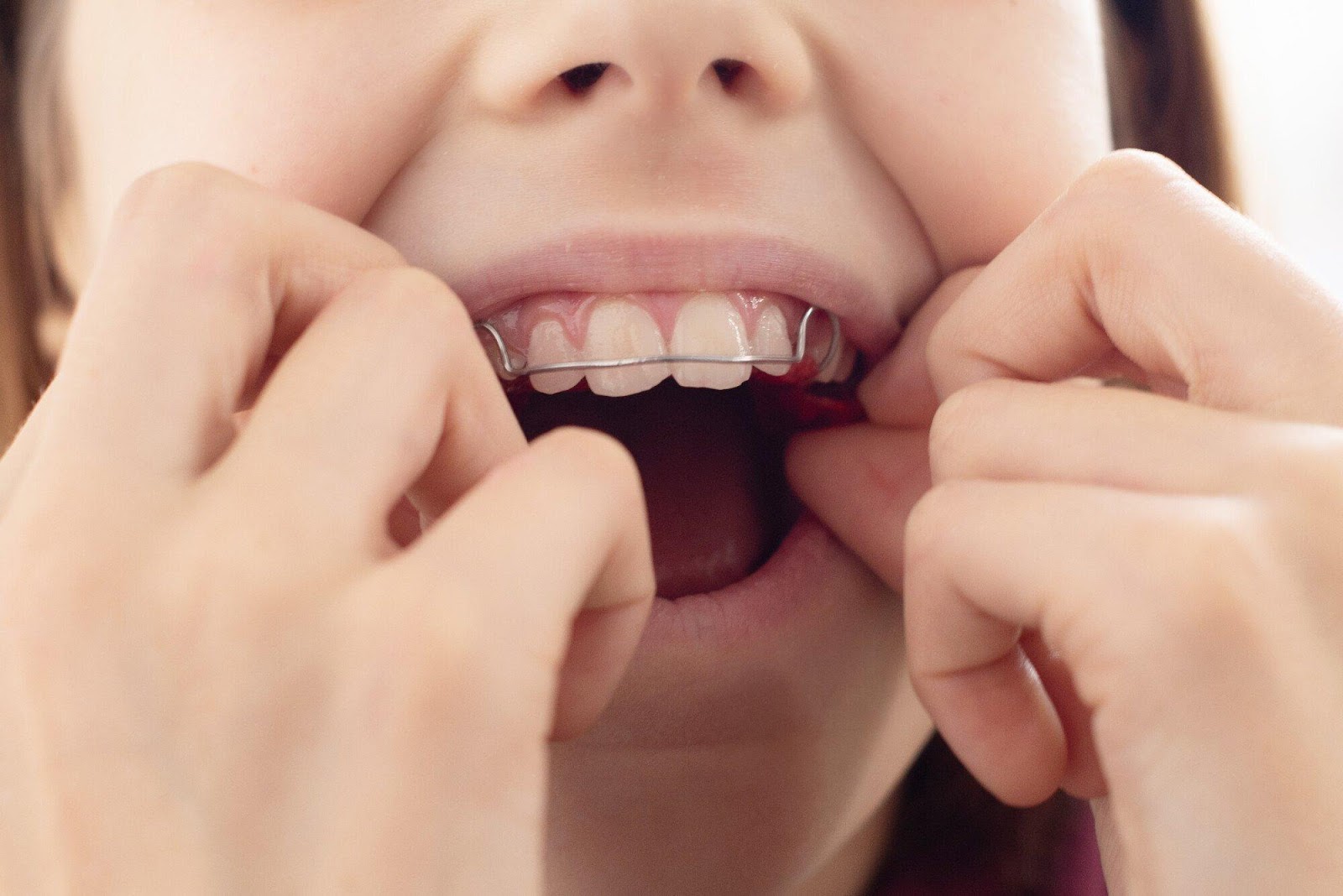 The Different Types Of Braces Appliances Which Is Right For You?