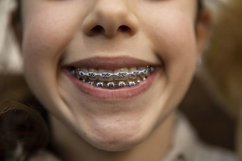 Halvorsen Orthodontics Easton Orthodontist Easton Orthodontics