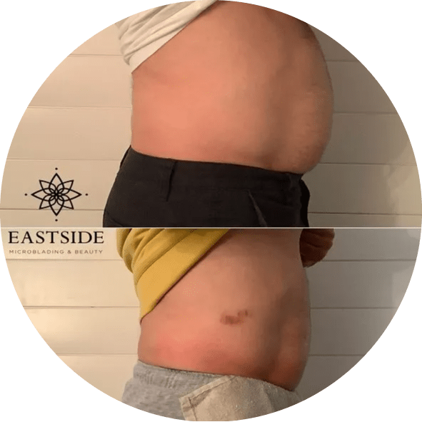 Cryo Body Sculpting in Airway Mobile Home Park, Washington Eastside Microblading Studio