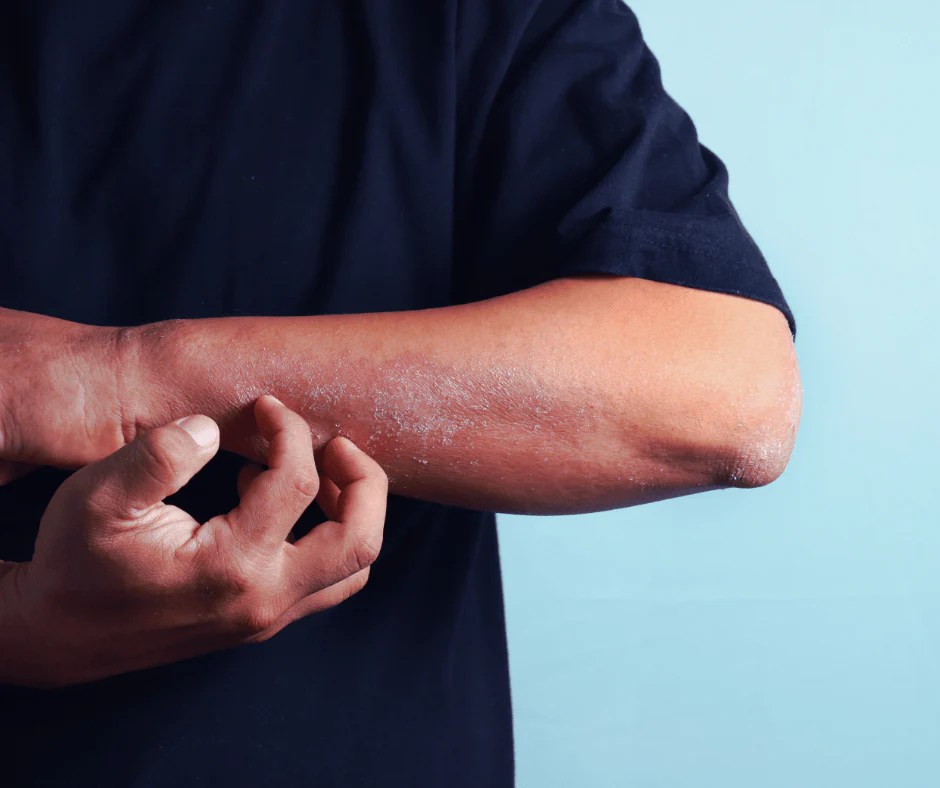 Eastwind Bamboo Bed Linen The Top Choice for EczemaProne Skin (save