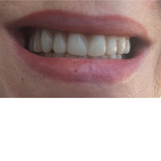 Buy Online Dentures Buy Top and Bottom Easy Dentures