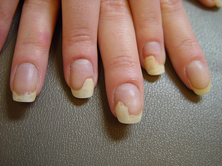 Fingernails are moving away from the skin causes and treatment of nail delamination