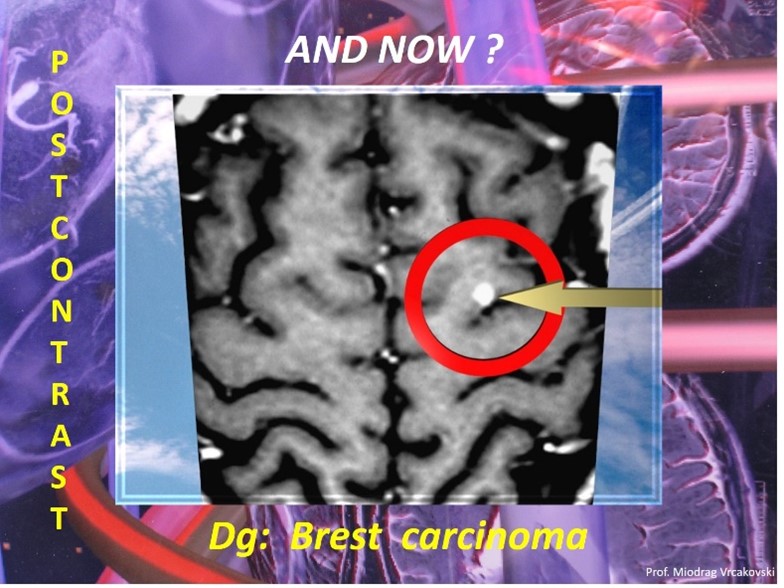 MRI CONTRAST AGENTS IN NEURORADIOLOGY HOW THEY ACT! Easy Neuroradiology