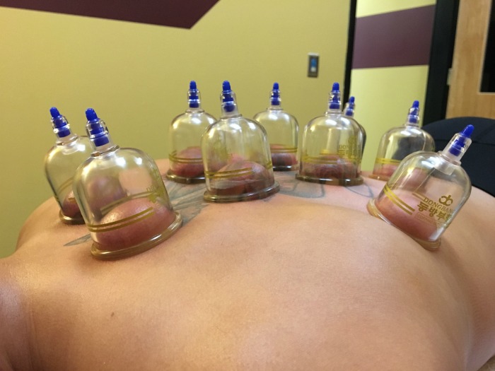 Cupping