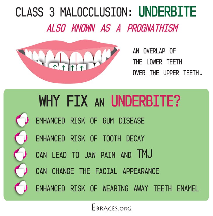 How To Fix Underbite In Toddler / She Will Amaze You SmooshFace