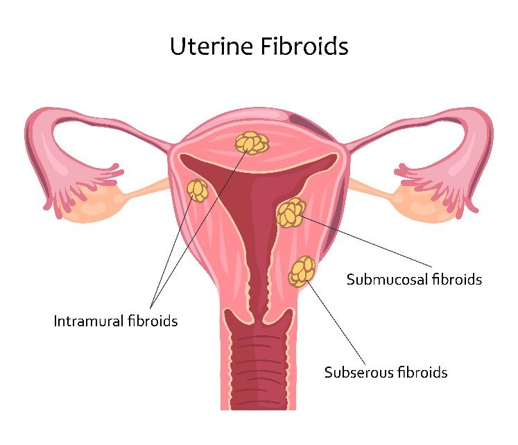 ECCO Medical Explaining Uterine Fibroids Causes, Symptoms and Treatments