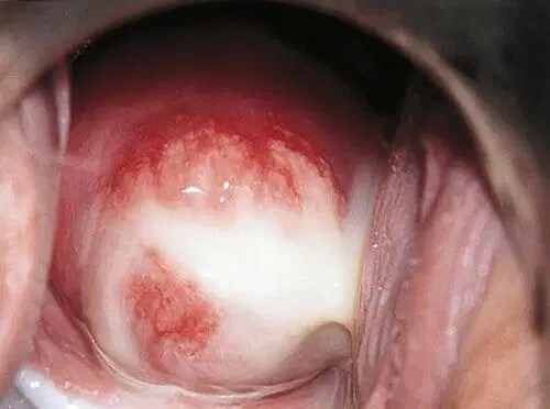 Chlamydia | Veel Voorkomende Ziekten | Menselijk Lichaam