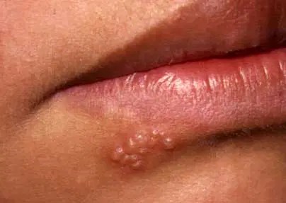 Herpes Simplex | Besmettelijke Ziektes | Menselijk Lichaam