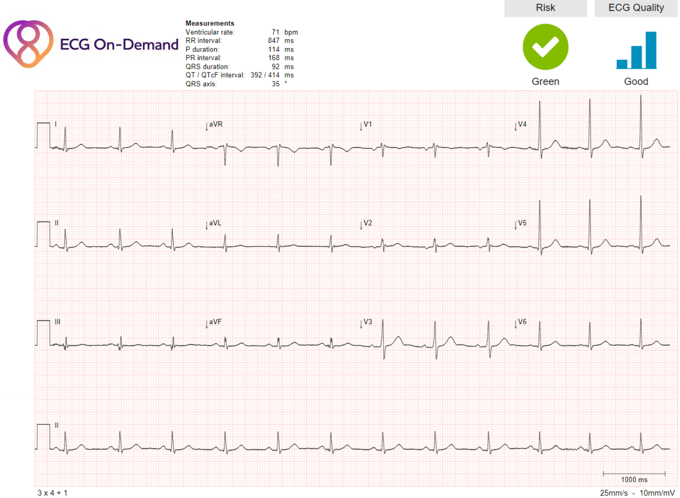 Sinus rhythm with Right Bundle Branch Block Ambulatory ECG