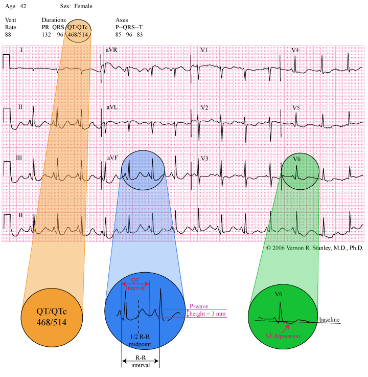 Measuring QT Prolongation & Bazett’s Equation