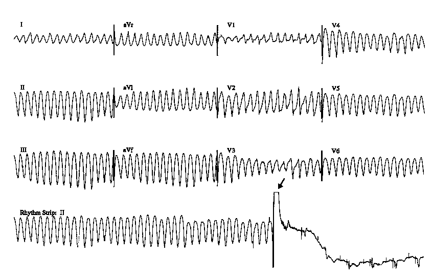 Implantable cardioverter defibrillator.