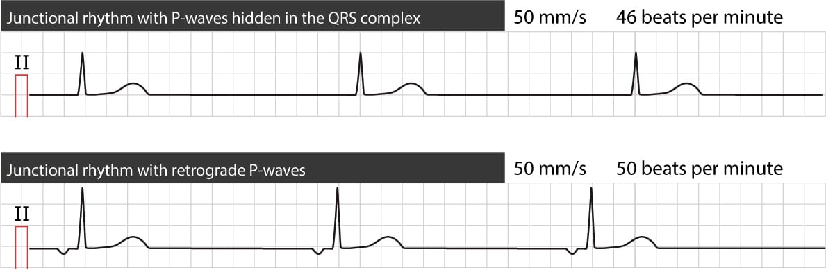 Figure 1. Two types of junctional (escape) rhythm. ECG learning