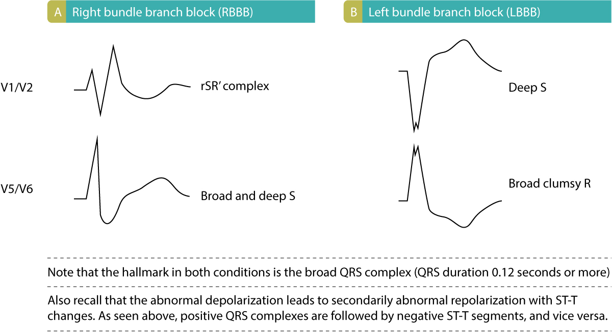 Intraventricular conduction delay bundle branch blocks & fascicular