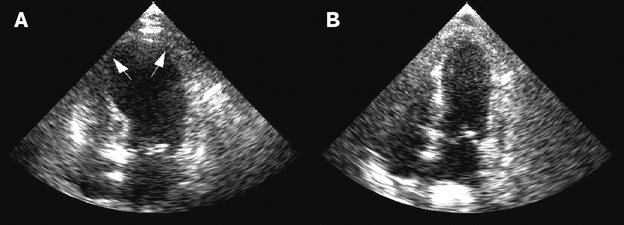 Takotsubo cardiomyopathy (broken heart syndrome, stress induced