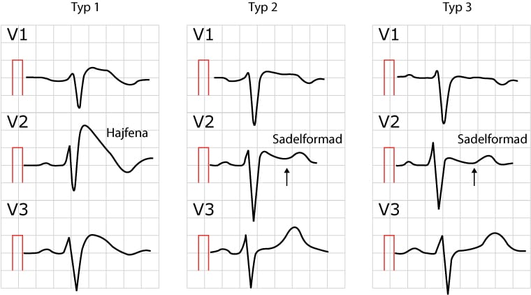 xDIFFBrugada ECG learning