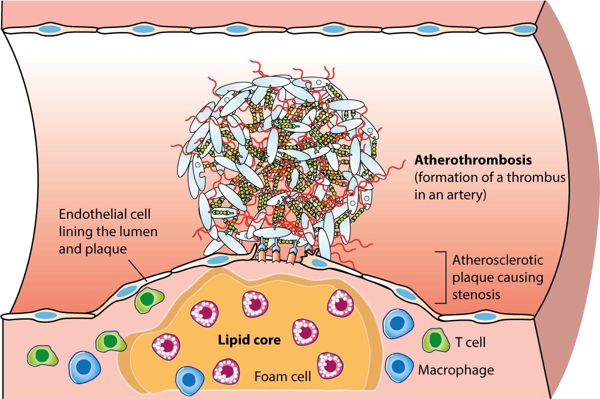 Introduction to Coronary Artery Disease (Ischemic Heart Disease) & Use