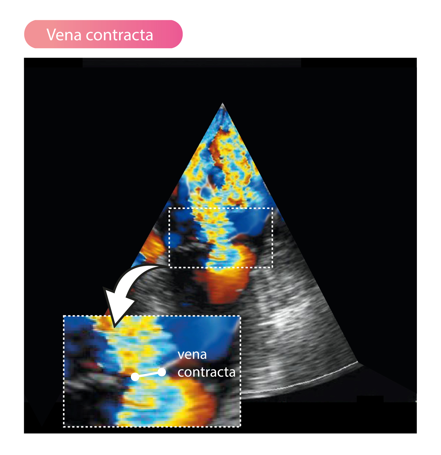 Proximal Isovelocity Surface Area (PISA) ECG &amp, ECHO