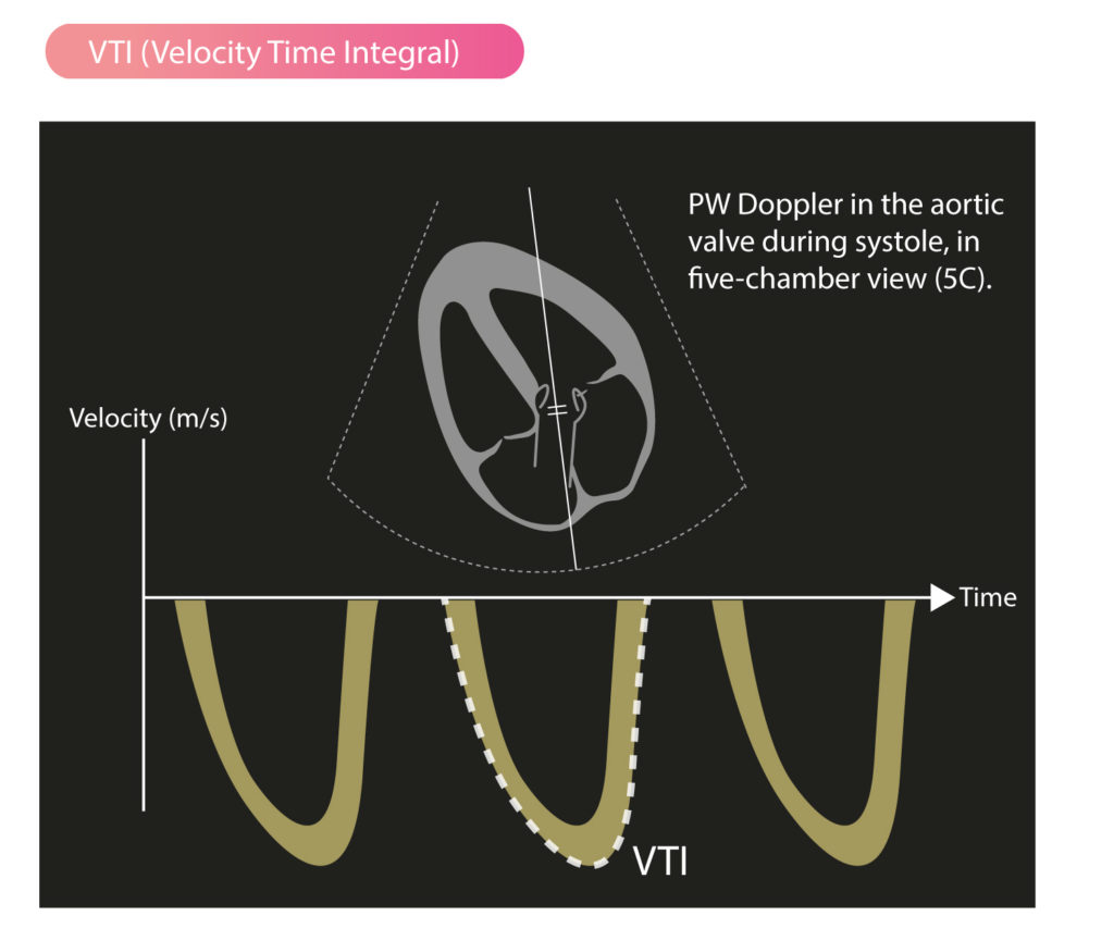 Stroke Volume, VTI (Velocity Time Integral) & Cardiac Output ECG & ECHO